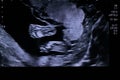 Tiny feet on 20 weeks old baby fetus at the half way ultrasound picture Royalty Free Stock Photo