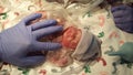 Tiny preemie baby girl moments after she was born Royalty Free Stock Photo