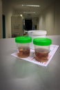 Tissue samples are placed in formalin for subsequent examination by a pathologist