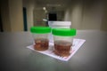 Tissue samples are placed in formalin for subsequent examination by a pathologist