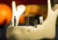 Abutments in the artificial jawbone Royalty Free Stock Photo