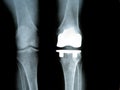 Titanium Knee