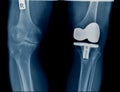 Hight quality x-ray with knee joint replacement Royalty Free Stock Photo