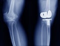 Hight quality x-ray with knee joint replacement