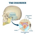 TMJ disorder vector illustration. Labeled jaw condition educational scheme. Royalty Free Stock Photo