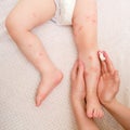 Toddler baby skin care, allergies and dermatitis. A mother woman sme Royalty Free Stock Photo