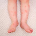 Toddler baby skin care, allergies and dermatitis. Red spots of allergy a Royalty Free Stock Photo
