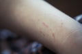 Toddler's bite marks on mothers arm - aggressive behavior in todd