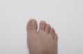 Toe with a buried and separate completely full of fungus known as: onychomycosis