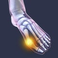 Toe deformation, also known as hallux valgus, or bunion