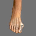 Toe deformation, also known as hallux valgus, or bunion