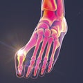 Toe deformation, also known as hallux valgus, or bunion