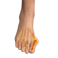 Toe deformation, also known as hallux valgus, or bunion