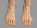 Toe deformation, also known as hallux valgus, or bunion