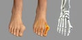 Toe deformation, also known as hallux valgus, or bunion