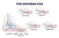 Toe deformities and medical foot phalanges bone defects outline diagram Royalty Free Stock Photo