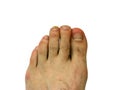 Toe nail with bruise