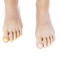 Toe nail fungus