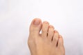 Foot disease Rheumatism and gout. Painful gout inflammation on big toe joint