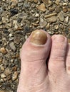 Toenail care for nail fungus - thickened big toe nail of a person suffering from Onychomycosis, a fungal infection causing yellow