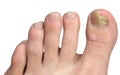 Toenail Fungus at Peak Infection