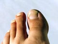 A toenail fungus at the peak of the infection. Painful toe contagious with onychomycosis. Active phase of the disease. untreated Royalty Free Stock Photo