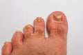 A toenail fungus Royalty Free Stock Photo