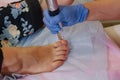 Toenail Fungus Treatment With Foot Laser At Laser Nail Therapy