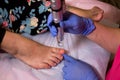 Toenail fungus treatment with foot laser at laser nail therapy