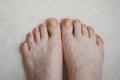 Toenails affected by fungal infection. Onychomycosis