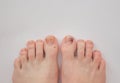 Toenails damaged by hematoma. Detachment of the nail, blow to the nail. Ingrown nail. Nail care concept