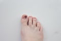 Toenails damaged by hematoma. Detachment of the nail, blow to the nail. Ingrown nail. Nail care concept