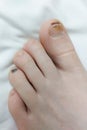 Toenails damaged by hematoma. Detachment of the nail, blow to the nail. Ingrown nail. Nail care concept