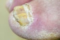 Toenails with fungal infection.