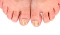 Toenails infected with fungus