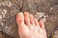 Toes Of Male Foot Infected With A Nail Fungus.