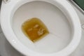 Toilet bowl containing dark urine