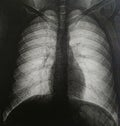 Tomography of human chest no pathologies Royalty Free Stock Photo
