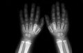 tomography of toddler hands. no pathologies Royalty Free Stock Photo