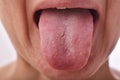 Tongue problem disease, Fissured white tongue.