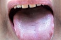 Tongue pulled out of the mouth, health assessment and oral examination