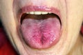 The tongue is red, inflamed. Hyperemia of the mucous membrane of the tongue