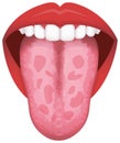 TongueÃ¢â¬â¢s health sign vector illustration Geographic Tongue