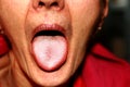 The tongue is in a white raid. Candidiasis in the tongue