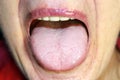 The tongue is in a white raid. Candidiasis in the tongue