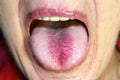 The tongue is in a white raid. Candidiasis in the tongue