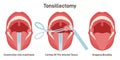 Tonsillectomy. Acute pharyngitis treatment, surgical removal of the tonsils,