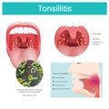Tonsillitis. Inflammation of the soft tissue in the mouth and pain in swallowing occurs. Illustration. Royalty Free Stock Photo