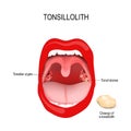 Tonsilloliths and halitosis. Human mouth. close-up of the tonsil