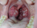 Tonsils. Angina. Tonsillitis. Bacterial disease produced in the tonsils that causes swelling and plaque. Bad mouth.